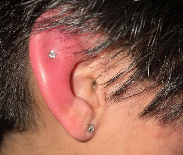 Is surgical steel good for piercing? Everything to know 4 Potential drawback of of Surgical Steel piercing